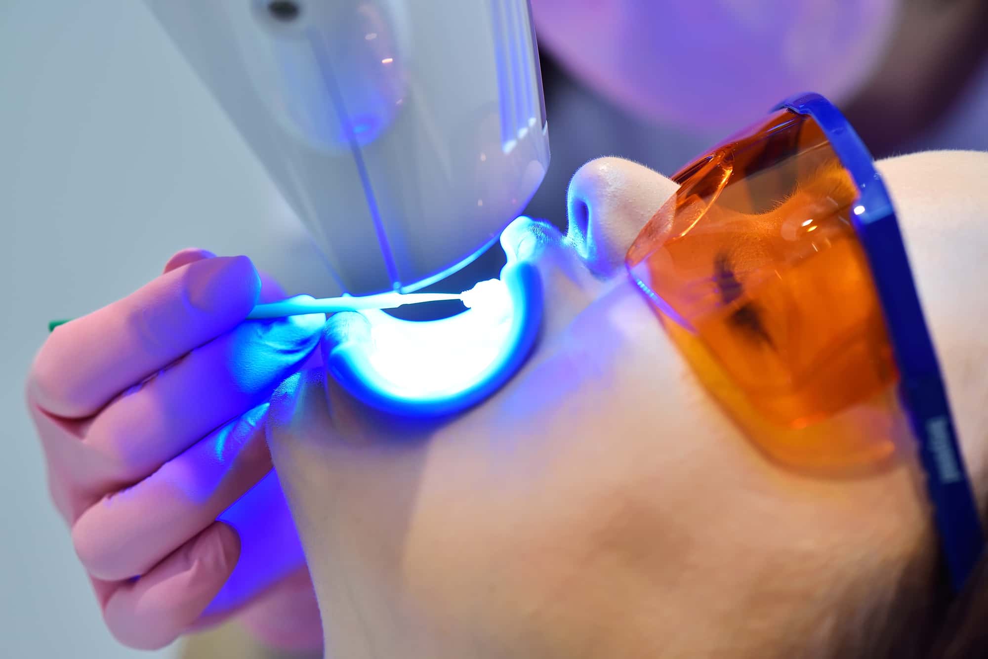 オフィスホワイトニングを受けている患者